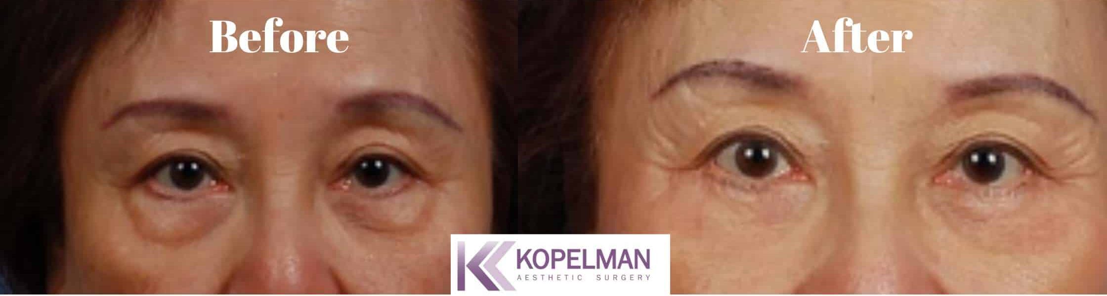 asian eyelids surgery before and after _ female patient 3