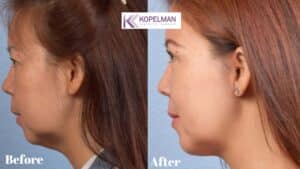 before and after _ chin implant