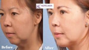 before and after _ chin implant side view