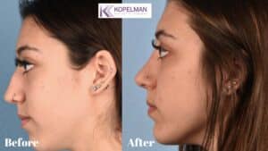 before and after female patient_ chin implant side view