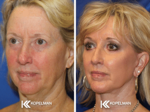 facelift before and after _ female