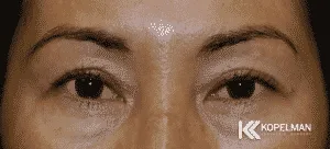 Asian-Eyelid-Crease_before-and-after-picture-2-300x136