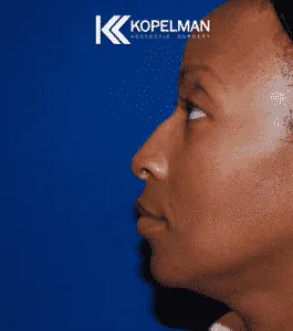 Chin-Implant-Before-Picture-265x300