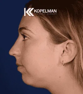 Chin-Implants-Before-After-Picture-2-265x300