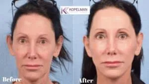 FL-Deep-Plane-Facelift-before-and-after-_-female-patient-2-front-view-300x169