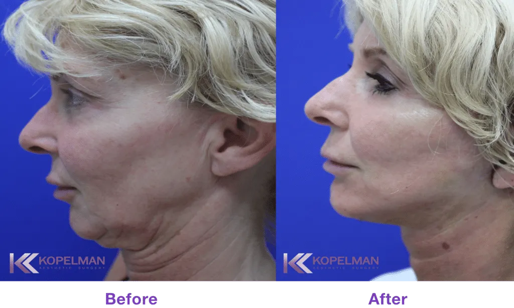 Mini Facelift in Palm Beach County Before & After