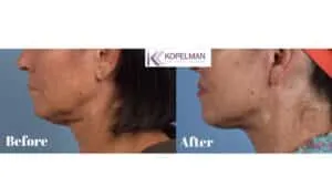 Miami-Deep-Plane-Facelift-and-after-_-female-patient-4-3-front-view-300x169