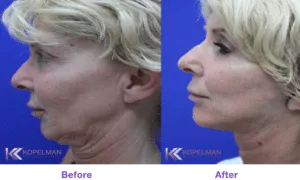 Miami-FaceLift-Before-After-300x180