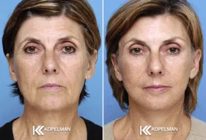 Miami-female-facelift-before-and-after-300x204