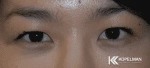 asian-blepharoplasty-NYC_before-and-after-picture-300x136