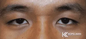 asian-blepharoplasty_before-picture-300x136