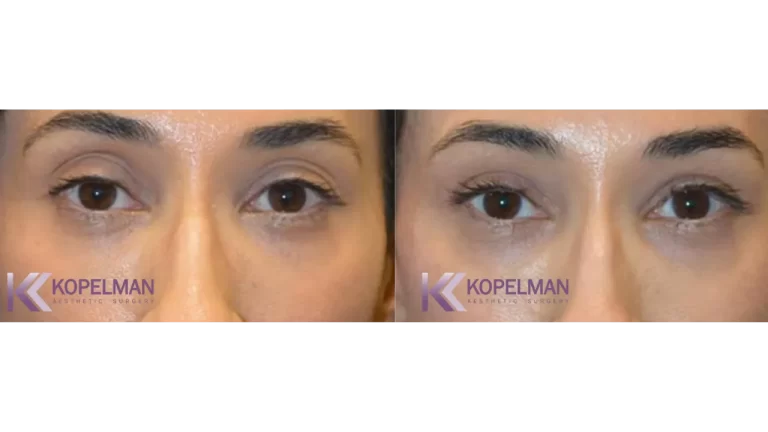 Female asian eyelid before & after