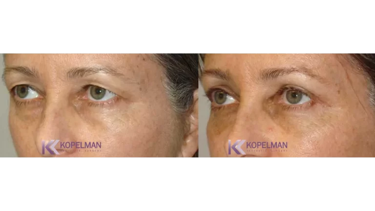 before and after female blepharoplasty surgery