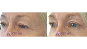 before-and-after-female-blepharoplasty-surgery-5-NYC