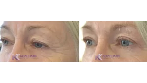 before and after female blepharoplasty surgery
