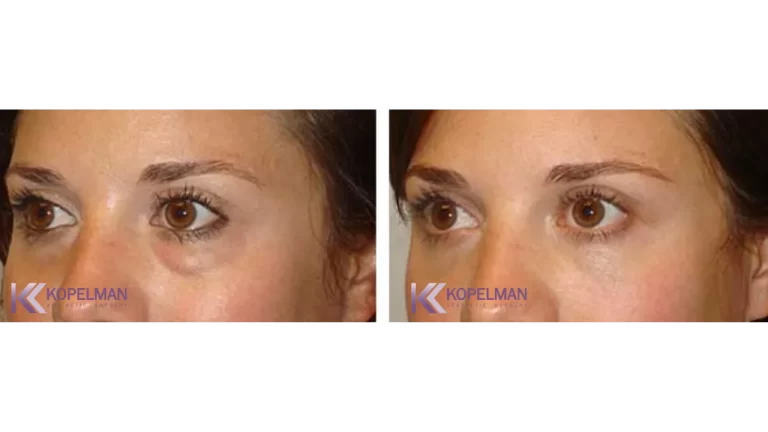 before and after female blepharoplasty surgery