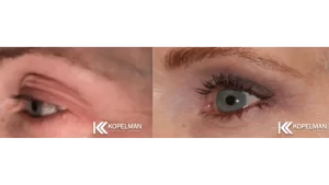 before and after female eyelid surgery