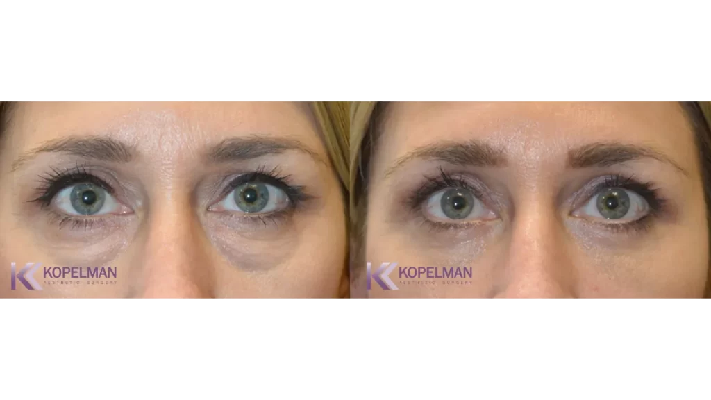 before and after female eyelid surgery