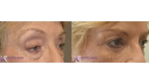 before-and-after-female-eyelid-surgery-4-NY