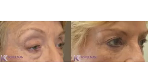 before and after female eyelid surgery