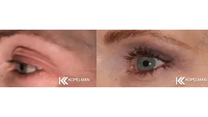 before-and-after-female-eyelid-surgery-Manhattan