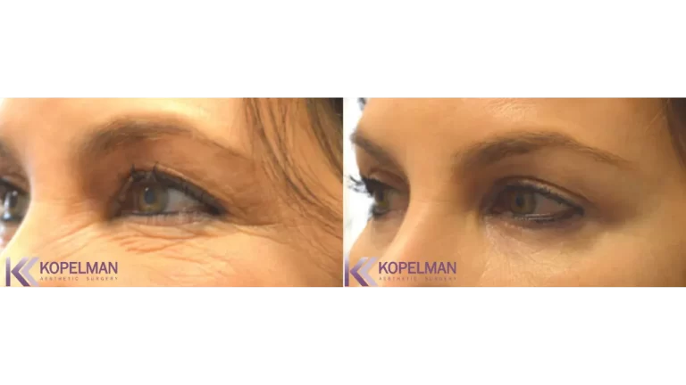 before and after female eyelid surgery