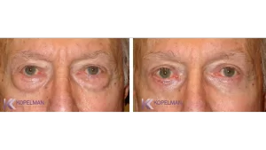 before-and-after-male-eyelid-surgery-2-New-York