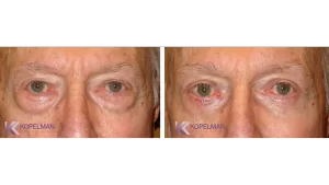 before and after male eyelid surgery