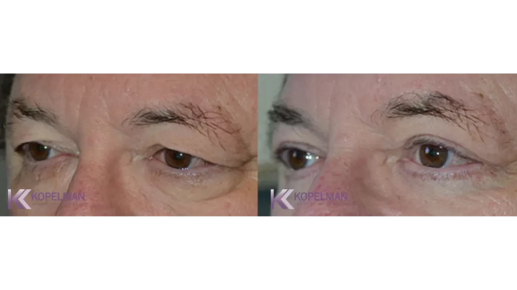 before and after male eyelid surgery