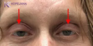 male-blepharoplasty-before-and-after-1-300x150