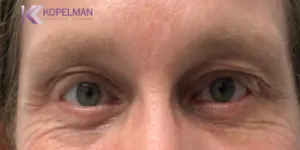 male-blepharoplasty_after-photo-1-300x150