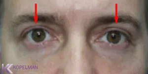 men_blepharoplasty-before-and-after-300x150