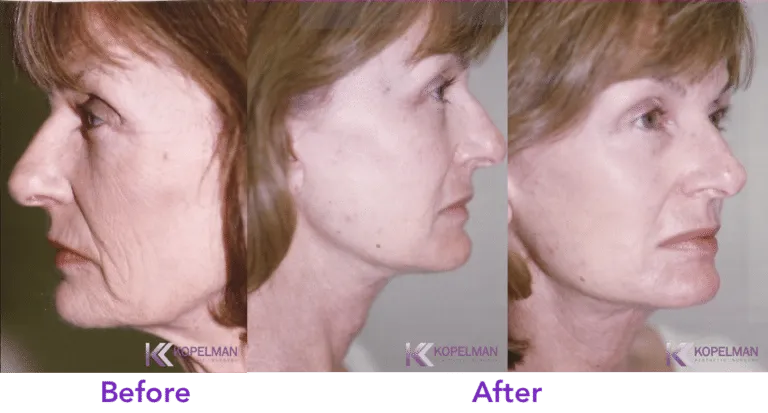 Facelift Surgery NY