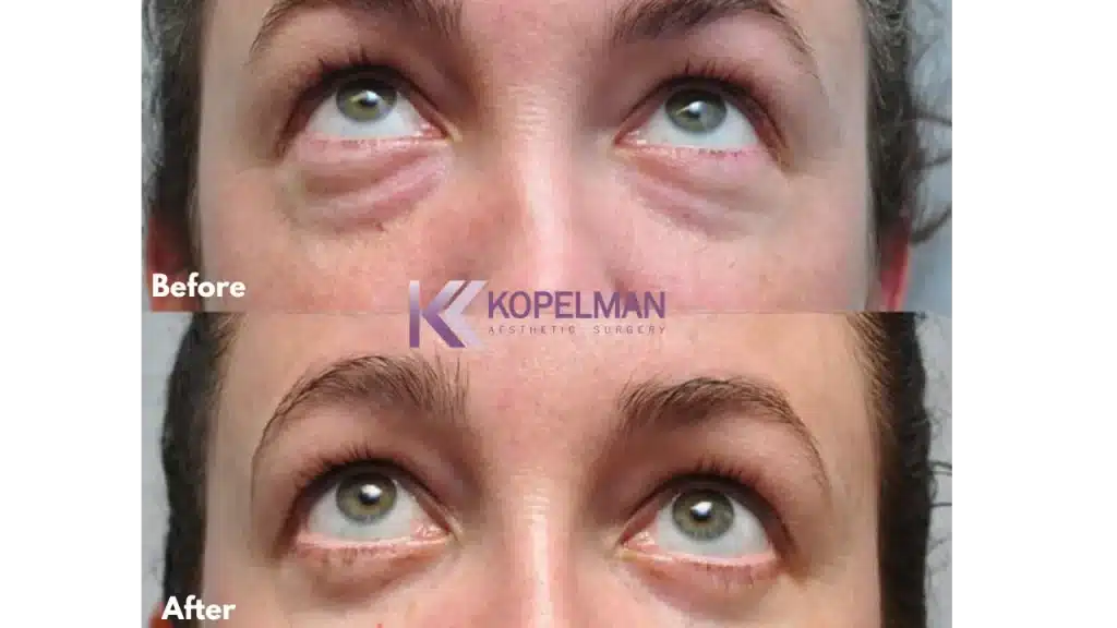 Before and After Lower Eyelid Surgery