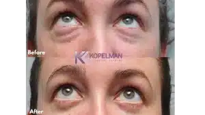 Before and After Lower Eyelid Surgery