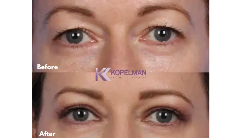 Before and After Upper Eyelid Surgery