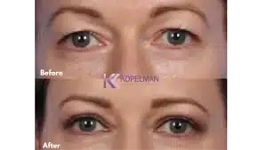 Before and After Upper Eyelid Surgery