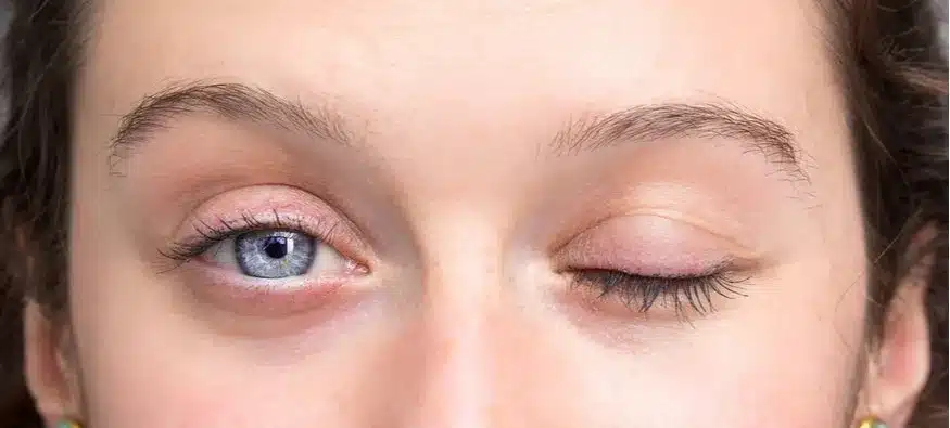 Botched Blepharoplasty