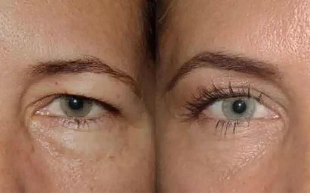 Browlift vs blepharoplasty