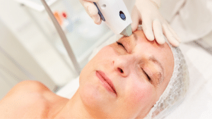 Ultherapy for eyelid lift