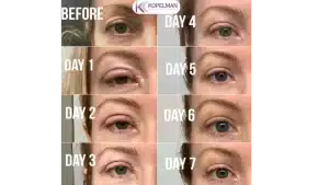 blepharoplasty recovery process