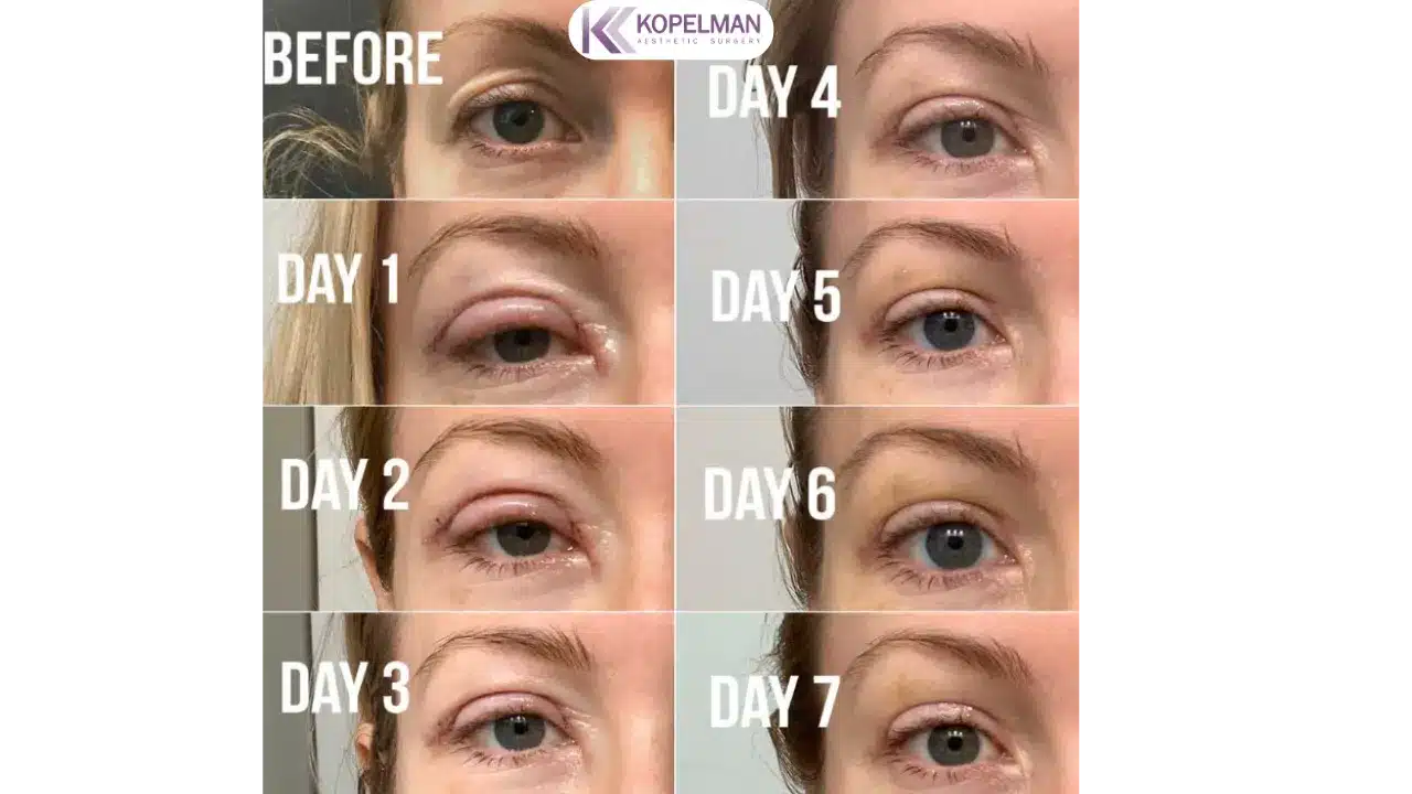 blepharoplasty recovery process