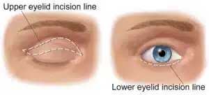 blepharoplasty surgery