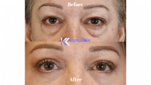 Laser Under Eye Bag Removal Before and After | Dr. Kopelman