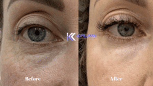Laser Under Eye Bag Removal Before and After | Dr. Kopelman