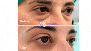 Laser Under Eye Bag Removal Before and After | Dr. Kopelman