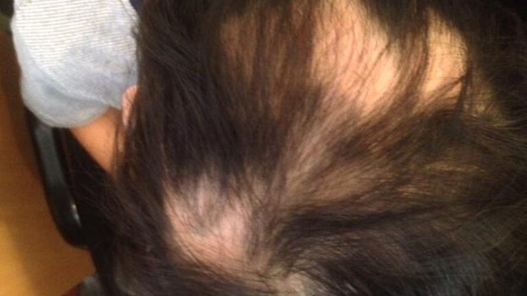 Pictures of Alopecia Hair Loss – Causes, Types, Treatments