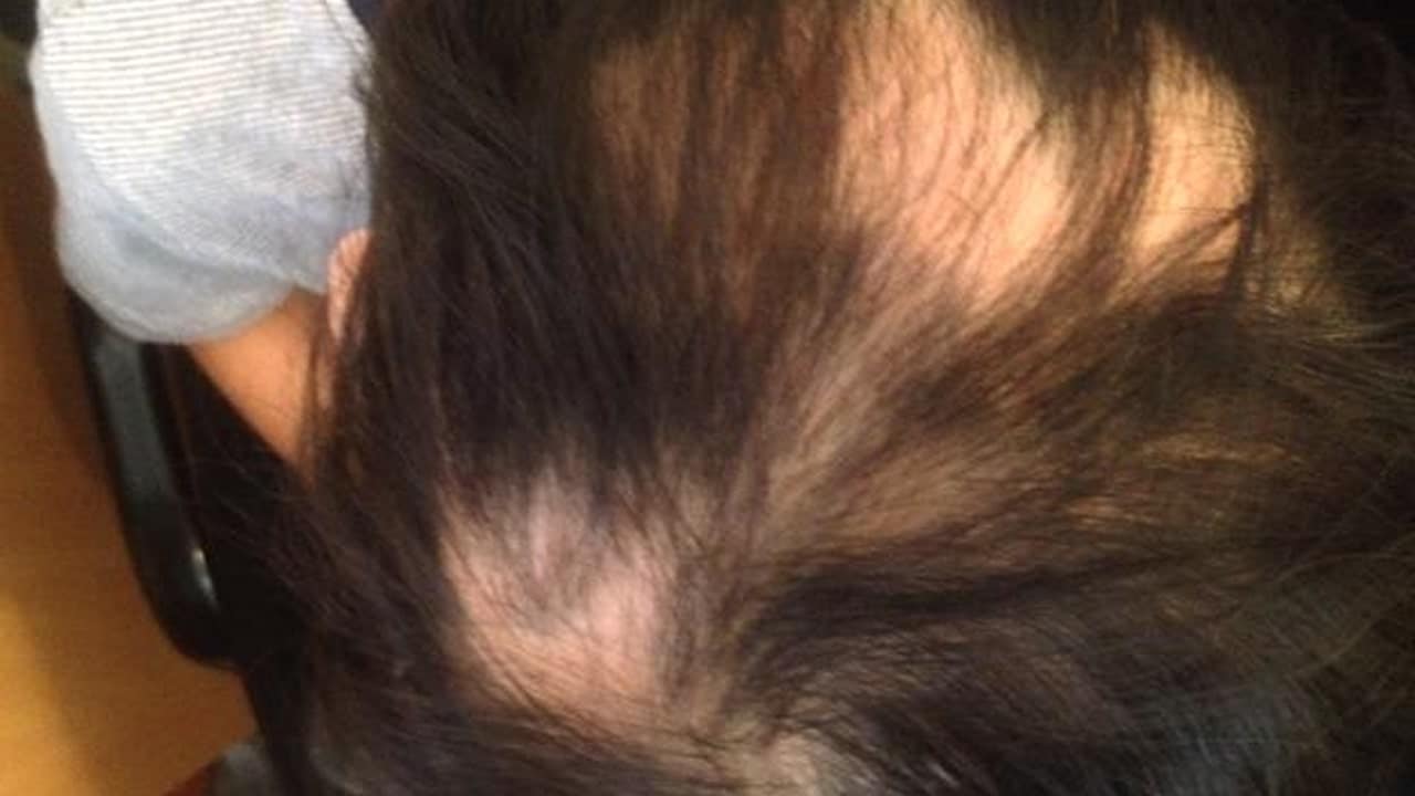 Pictures of Alopecia Hair Loss – Causes, Types, Treatments