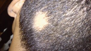 Pictures of Alopecia Hair Loss – Causes, Types, Treatments