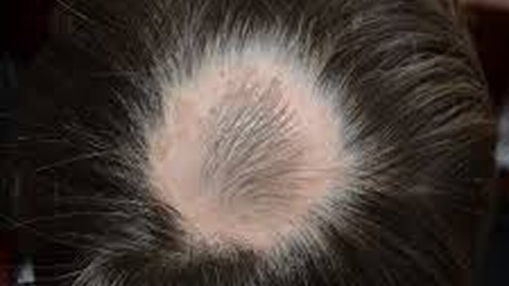 Pictures of Alopecia Hair Loss – Causes, Types, Treatments